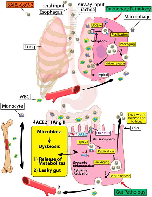 Figure 7. Dysregulated RAS in lung and gut epithelium of individuals with diabetes with COVID-19. ACE2, a pleiotropic regulator of the RAS, is hijacked as a receptor for SARS-CoV-2 to promote viral infection. Loss of ACE2 indirectly via proteolytic processing, autophagy, and ADAM17-mediated shedding (not shown) partly drives not only lung but also gut disease in individuals with diabetes with COVID-19. SARS-CoV-2 S1 binding to ACE2 initiates internalization of ACE2:B0AT1 complex (gut) or ACE2 (outside of gut). Thus, SARS-CoV-2 by downregulating intestinal ACE2-B0AT1 would promote leaky gut syndrome with elevated plasma bacterial lipopolysaccharides and/or peptidoglycans enhancing systemic inflammation. In the lung, virus internalization also promotes a reduction in ACE2 that results in pulmonary pathology. Careful targeting of the RAS axis will likely optimize clinical outcomes in subjects with diabetes infected with SARS-CoV-2. WBC, white blood cell.