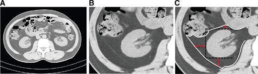 Figure 2. Measurement of PRFT. As shown in A, PRFT was measured in the central slice of renal hilum (defined as the central slice of pelvis). As shown in B and C, PRFT was measured from the following three directions: 1) anterior, the vertical distance from top of anterior border of kidney to anterior renal fascia or the closest visceral organ; 2) lateral, the vertical distance from top of lateral border of kidney to lateral perirenal fascia or the closest visceral organ; and 3) posterior, the vertical distance from top of posterior border of kidney to posterior renal fascia.