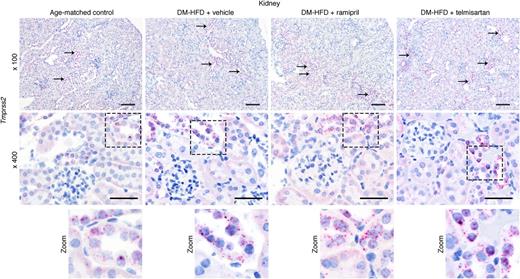 Figure 6. Predominant expression of Tmprss2 in distal nephron segments in the kidney cortices of RAS blocker–treated, aged, DM-HFD mice. Ramipril (10 mg/kg/day) or telmisartan (3 mg/kg/day) were dosed to aged DM-HFD mice for 2 weeks. RNAscope in situ hybridization for Tmprss2 (top magnification ×100 [scale bars = 100 μm], bottom magnification ×400 [scale bars = 50 μm]). The arrows label some of the kidney tubules in each section that contain red RNAscope puncta in the lower magnification (×100) images. The zoomed-in images are enlargements of the boxed areas in the higher magnification (×400) images.