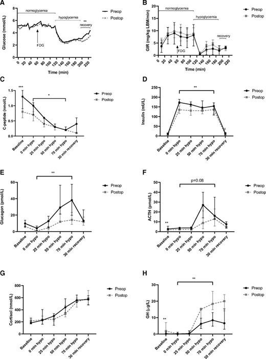 Figure 2. A–H: Glucose levels, glucose infusion rates, and hormone levels during normoglycemic and hypoglycemic clamp. Data are median ± IQR (all but panel A) or mean ± SD (A). *P < 0.05, **P < 0.01, ***P < 0.001. P values refer to differences between pre- and postsurgery, during the hypoglycemic period (brackets, AUCs) or fasting levels (baseline). P values within brackets refer to Wilcoxon signed rank tests of ΔAUC (for all panels except D, where total AUC is shown). GIR, glucose infusion rate; hypo, hypoglycemic phase of clamp; LBM, lean body mass; Preop, preoperative; Postop, postoperative.