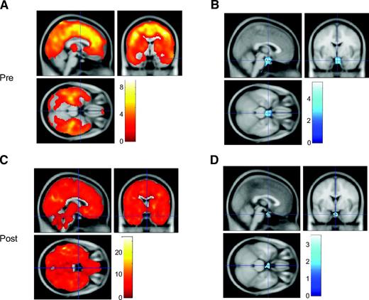 Figure 4. Difference in 18F-FDG net influx rates between hypo- and normoglycemic clamp periods. PET statistical parametric mapping (SPM) T-maps show comparisons from the presurgery (A and B) and postsurgery (C and D) investigations, respectively. A and C show clusters with significantly increased 18F-FDG net influx rate for hypo- vs. normoglycemia (red), whereas B and D show clusters with significant reduction (blue). The color maps represent T-values, indicating the number of pooled standard deviations between net influx rate values during hypo- vs. normoglycemia, where T > 1.96 corresponds to P < 0.05. Minimum cluster size for significance was 50 voxels (0.4 cm3). The crosshairs are centered on the hypothalamic cluster in panel B and the peak coordinates (MNI) are 0, −8, −22.