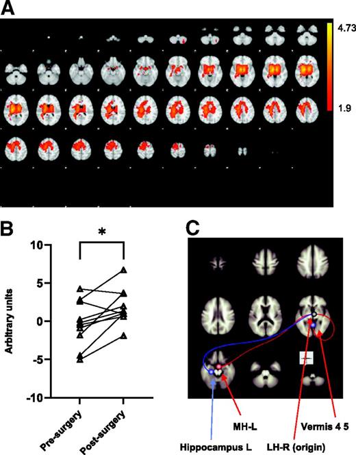 Figure 6. fMRI. A: TICA across all six resting fMRI runs revealed one IC, which represents a functional connectivity resting-state network, explaining most variability. This resting-state network was defined purely on the provided data without prior assumption and includes, notably, bilateral thalamus and hypothalamus. The activity of this IC was significantly higher after vs. before surgery (red color; S-mode) during the first 20 min of the hypoglycemic clamp (i.e., rapid glucose lowering) (P < 0.05). The color code represents T-values. B: Individual data of the above IC activity (S-mode) during the initial phase of hypoglycemia. *P < 0.05. C: The ROI functional connectivity analysis using the right LH as seed region as defined on the basis of previous literature (31). During initial hypoglycemia, there was a significantly decreased functional connectivity to left hippocampus and a significantly increased functional connectivity to vermis regions 4 and 5 for the post- vs. presurgery condition. Similar increases in connectivity to corresponding regions were obtained using the left LH as seed region (data not shown). n = 10. L, left; LH, lateral hypothalamus; MH, medial hypothalamus; R, right.