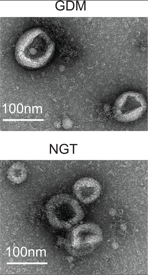 Transmission electron microscopy images of plasma exams from pregnant women with GDM or normal glucose tolerance (NGT).