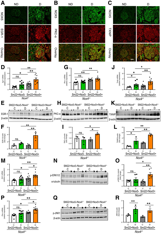 Modulation of ROS-sensitive factors EGR-1, PKC-α/ε, ERK1/2, and TXNIP by NOX5 in DKD. Immunostaining for EGR-1 (A), PKC-α (B), and TXNIP (C) in human kidney biopsy specimens obtained from nondiabetic (ND) individuals and patients with diabetes (D). Scale bar, 50 μm in all photomicrographs. Renal cortical gene (n = 8–10/group) and protein (n = 3–6/group) expression of EGR-1 (D–F), PKC-α (G–I), TXNIP (J–L), and pERK1/2 (M–O), as well as gene expression of PKC-ε (P) and protein expression of pJNK1 (Q and R) in all groups of Nox4 KO (Nox4−/−) mice with and without NOX5 expression after 10 weeks of STZ-diabetes. Molecular weight of EGR-1 (75 kDa), PKC-α (77 kDa), TXNIP (50 kDa), pERK1/2 (44 and 42 KDa), pJNK1 (49 kDa), β-actin (42 kDa), and α-tubulin (50 kDa). β-actin and α-tubulin are housekeeping proteins. Data are shown as mean ± SEM. *P < 0.05, **P < 0.01. C, control; D, diabetic; ns, not significant statistically.
