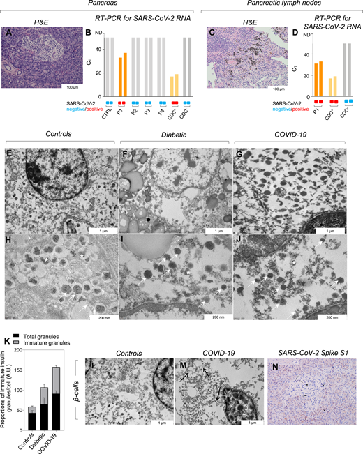 Abnormalities in the endocrine pancreas are observed in patients with COVID-19. A: Histologic examination of pancreatic section retrieved from a patient with COVID-19 stained with H-E showing mild islet lymphocytic infiltration. B: Bar graph showing the results of a SARS-CoV-2 RT-PCR assay using the 2019-nCoV_N1 and 2019-nCoV_N2 primer probe sets performed on RNA samples extracted from pancreatic sections from patients with COVID-19 (P1, P2, P3, and P4) and from healthy control subjects, showing detectable viral RNA in patient P1. RNA extracted from a Centers for Disease Control and Prevention (CDC)–positive control DNA plasmid (CDC+) was used as a positive control, and RNA extracted from a CDC-negative sample (CDC−) was used as a negative control. Cycle threshold (CT) values are shown. C: H-E staining of PLNs from a patient with COVID-19. D: Bar graph depicting the results of a SARS-CoV-2 RT-PCR assay using the 2019-nCoV_N1 and 2019-nCoV_N2 primer probe sets performed on RNA samples extracted from PLNs from a patient with COVID-19 (P1), showing detectable viral RNA in patient P1. RNA extracted from a CDC+ control DNA plasmid was used as a positive control, and RNA extracted from a CDC− sample was used as a negative control. CT values are shown. Magnification in panels A and D, ×10 and panel C, ×20; scale bars in panels A and D, 100 μm and panel C, 100 μm. E–J: Transmission electron microscopic analysis of pancreatic tissue from patients with COVID-19 as compared with healthy control subjects and patients with type 2 diabetes, showing similar islet alterations in pancreatic tissues from patients with COVID-19 and patients with type 2 diabetes; arrows indicate the presence of insulin secretion granules; in healthy control subjects, arrows delineate insulin granules with different degrees of granulation; in diabetic samples as well as in COVID-19 samples, arrows delineate β-cells with several immature granules. Asterisks in panels H, I, and J show mature insulin granules. K: Quantification of the proportions of immature insulin granules per total mature insulin secretion granules; n = 3 cases per section were analyzed. L and M: Transmission electron microscopic analysis of pancreatic tissue from a patient with COVID-19 as compared with that from healthy control subjects depicting the presence of several vacuoles (shown by black arrows) in the vicinity of β-cells from a patient with COVID-19. N: SARS-CoV-2 spike S1 staining depicted within endocrine cells; arrows indicate the positive staining within endocrine cells of the pancreas; asterisk refers to an islet, and arrowheads indicate pancreatic acinar cells. AU, arbitrary unit.