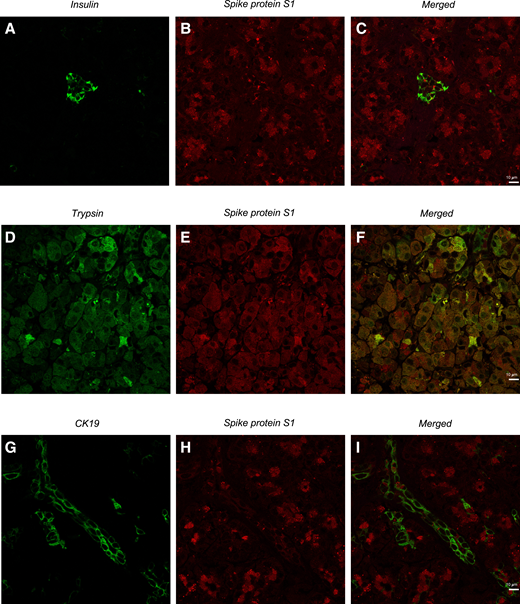 SARS-CoV-2 spike protein S1 localizes within endocrine pancreatic β-cells and exocrine pancreatic cells. A–I: Confocal microscopic analysis of pancreatic tissue from a patient with COVID-19 depicting the localization of SARS-CoV-2 spike protein S1 within β-cells (insulin-positive cells) (shown in panel C) and within exocrine cells, trypsin-positive cells (shown in panel F), and CK19-positive cells (as shown in I). Scale bars in panels A–I, 10 μm.