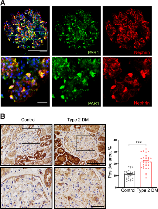 PAR1 expression in human glomeruli. A: Expression of PAR1 in human podocytes. Representative microphotograph of decapsulated human glomerulus freshly isolated from kidney cortex. Immunolabeling demonstrates colocalization of PAR1 (green) and nephrin (red; podocyte-specific marker) proteins. Cell nuclei are blue. Merged and separate confocal images for PAR1 and nephrin are shown (top: scale bar is 50 μm; bottom, scale bar is 25 μm). B: Immunostaining for PAR1 expression of control and diabetic samples (top, scale bar is 100 μm; bottom, scale bar is 25 μm). Black rectangles in the top images highlight the specified areas, which are zoomed-in in the bottom images, demonstrating the PAR1 expression in glomeruli. Summary of protein expression levels in the group without diabetes compared with the group with diabetes (11.2 ± 3.7 vs. 21.7 ± 6%, n ≥ 29 regions of interest, N = 3 samples, ***P < 0.001).