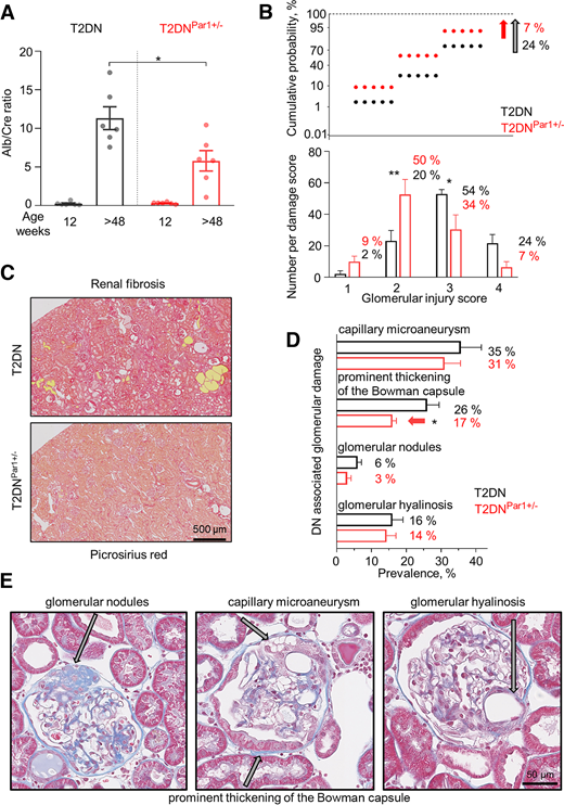 Attenuated development of microalbuminuria and glomerular damage in T2DNPAR1+/− rats. A: The progression of albuminuria was significantly lower in old T2DNPAR1+/− rats (24-h metabolic cages/urinary albumin normalized to creatinine, n = 6 each group, two-way ANOVA, *P < 0.05, factor 1: 12 vs. 48 weeks of age, factor 2: T2DN vs. T2DNPAR1+/−). B: The glomerular injury score (0–4, where 0 denotes no damage) was assessed by semiquantitative morphometric analysis for >48-week-old T2DNPAR1+/− and T2DN rats. (top) The cumulative probability distributions of the obtained glomerular scores. (bottom) Numbers of glomeruli per score are shown on the y axes. The percentage of glomeruli within the selected score range defined from cumulative distribution is shown. The prevalence of observed glomerular damage was clinically associated with DN in both groups (n ≥ 100, N ≥ 3, two-way ANOVA, *P < 0.05, **P < 0.015). Note relativity attenuation in the presence of glomerular pathology in T2DNPAR1+/− rats (D). Results show a significant decrease in the prominent thickening of basement membrane (t test, *P < 0.05), while other parameters exhibit a noticeable, yet nonsignificant trend toward reduction: capillary microaneurysm (35% vs. 31%; reduction 12%); glomerular nodules (6% vs. 3%; reduction 50%); glomerular hyalinosis (16% vs. 14%; reduction 13%). C: Renal fibrosis obtained by picrosirius red staining correlates with a significant decrease in kidney injury markers shown above. E: Masson trichrome-stained images show examples of glomerular damage in T2DN rats, as indicated by arrows.