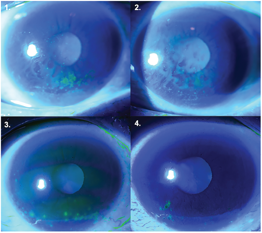 Ocular surface superficial punctate keratopathy before (1 and 2) and after (3 and 4) fenofibrate treatment.