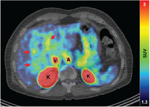 Quantification of PET/CT image. A, abdominal aorta; K, kidneys; SUV, standardized uptake volume, ranging from 1.3 to 3; V, vena cava.