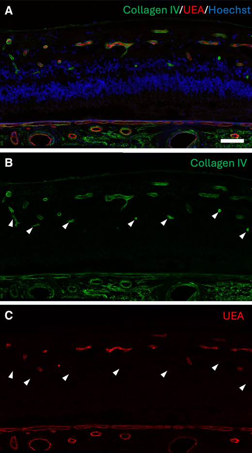 Immunostaining showing ghost vessels in the retina from a donor with diabetes. A–C: Immunohistochemistry from a region with acellular capillaries (arrowheads) showing collagen IV–stained basement membrane (green in A and B) and UEA-labeled endothelial cells (red in A and C). Arrowheads indicate ghost vessels, where endothelial cells have disappeared and only basement membrane remains. Scale bar = 50 μm.