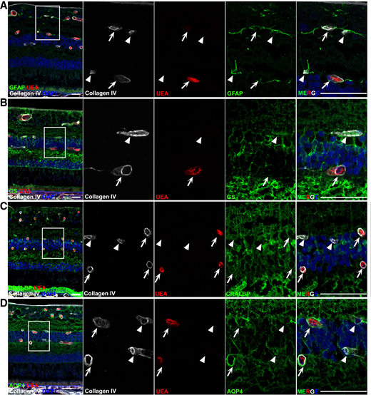 Gliovascular units in diabetic retina. A–D: Immunohistochemistry using antibodies against widely recognized glial marker GFAP (A), glutamine synthetase (GS) (B), CRALBP (C), and AQP4 (D) from consecutive sections of eyes from donors from the DDO subgroup (green), counterstained against collagen IV (white) and UEA (red). Merged images of the three channels are in the first and last (MERGE) column. Arrowheads point at acellular capillaries and arrows point to normal capillaries. Glial interface formed by retinal astrocytes was intact regardless of vascular dropout (A). GS and CRALBP are highly expressed in Müller cell endfeet at the inner limiting membrane and the outer limiting membrane, and less involved in the gliovascular interface (B and C). AQP4 expression is especially concentrated around glial cell endfeet around vessels, which remained present around acellular capillaries (D, arrows), but staining intensity was notably reduced (D, arrowheads). Scale bar = 50 μm in images at lower magnification and 25 μm in zoom-in images.