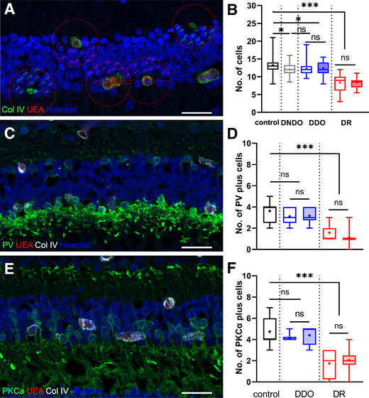 Identifying overall and subpopulation cell loss in the INL. A, C, and E: Confocal microscopy image showing the measurements of INL cell nuclei within the zone of influence of DVP capillaries (circle, A). Examples of normal capillaries (magenta counting marks) and nonperfused capillaries (green counting marks) are shown. Horizontal (C) and bipolar cells (E) were visualized using antibodies against PV and PKCα, respectively. B, D, and F: Quantification of total cells (B) and interneurons (D and F) within deeper capillary zones of influence. Normal capillaries are shown by empty boxes; nonperfused capillaries are shown by filled boxes. Control group, n = 3; DNDO subgroup, n = 4; DDO subgroup, n = 5; and DR, n = 1. Box represents 25th, median, and 75th quartiles; + indicates the mean value. Whiskers represent maximum and minimum. *P < 0.05, ***P < 0.0001. Statistical significance was tested by unpaired two-tailed Student test (intragroup differences) or one-way ANOVA with Dunnett post hoc comparison with control (intergroup differences). Scale bar = 25 μm.