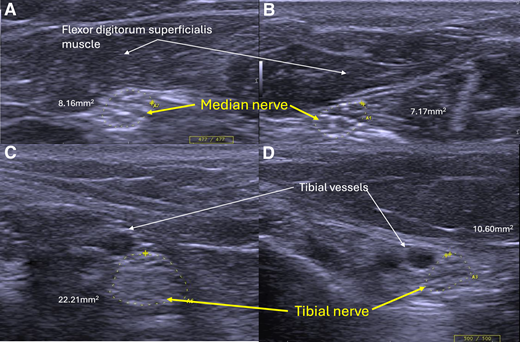 Peripheral nerve ultrasound images of individual participants from the nonmetformin group (left) and metformin group (right). Cross-sectional images were obtained of median (A and B) and tibial nerves (C and D). Left-sided panels (A and C) were taken from a participant receiving glicazide as monotherapy (TNS, 13; mTCNS, 8), whereas the participant in right-sided panels (B and D) was receiving metformin, again as monotherapy (TNS, 6; mTCNS, 6).