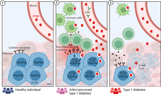 Hypothesis model of CTSS secretion from human β-cells in type 1 diabetes. 1: A basal level of cathepsin S (CTSS) is detectable in the blood of healthy individuals. 2: Upon immune cell infiltration of the pancreatic islets of Langerhans, proinflammatory cytokines are secreted from both immune cells and β-cells. The cytokines will induce transcription of CTSS in the β-cells, resulting in increased translation and secretion of CTSS from the β-cells. Thus, in autoantibody (AAb)-positive (+) and preonset type 1 diabetes individuals, elevated levels of circulating CTSS are detectable, which, at least in part, derive from inflammation-induced secretion from β-cells. A degree of secreted CTSS also derives from activated immune cells, for example, macrophages. 3: After established type 1 diabetes, accompanied by the depletion of β-cells and reduced islet inflammation, the circulating CTSS level declines. Thus, CTSS may be a biomarker of islet inflammation and loss of β-cells during the development of type 1 diabetes. Future studies are warranted to explore the molecular mechanisms underlying the transcription and secretion of CTSS in β-cells and its biomarker potential in type 1 diabetes. Created with BioRender.com.