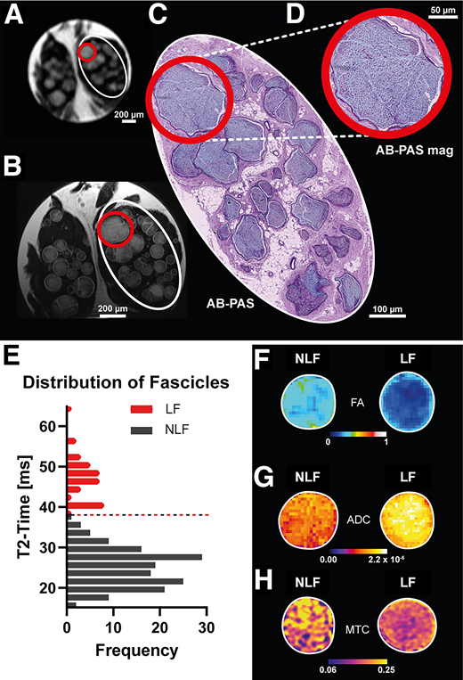 MRN of FLs. Clinical resolution T2-weighted MRN at 3 Tesla, individual nerve fascicles can be visualized within the sciatic nerve with typical hyperintensity of nerve lesions (red circle). A: At 9.4 Tesla ultra-high-field MRN, subfascicular internal structures of the same specimen are visible with a corresponding diffuse hyperintensity of fascicular nerve lesions. Corresponding histomorphology of the tibial portion of the sciatic nerve (white ellipsoid in A–C) (B) in the AB- PAS staining (C). D: Magnified MRN identified fascicular nerve lesion (red circle) corresponding to increased fascicular AB positivity. E: An unbiased approach based on a two-component gaussian-mixture-model applied to T2 time was used to identify nerve lesions (red bars) on MRN above a threshold value of 37.6 ms (dashed line). Fascicles below this threshold were considered as NLFs (black bars), whereas fascicles above this threshold were considered as LFs (red bars). F: On multiparametric quantitative MRN, DN nerve lesions exhibit the same MR morphotype compared with in vivo findings. An example pair of NLFs and LFs shows a typical decrease of fractional anisotropy (FA) (F), increase of apparent diffusion coefficient (ADC) (G), and a decrease of magnetization transfer contrast (MTC) (H).