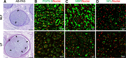 Morphological characterization of NLFs and LFs. A: Representative images of NLFs and LFs stained with AB-PAS. Lesions were visually larger and less compact and showed indications of having increased interstitial spaces. These spaces either remained emptied or contained mucin depositions (black arrows). F, fascicle body; P, perineurium. Scale bar = 200 µm. Immunofluorescent analysis of NLFs and lesions for the neuronal markers, neuron cytoplasmic protein gene product 9.5 (PGP9.5) (B), myelin basic protein (MBP) (C), and neurofilament-light (NFL) (D). Fascicles were stained for the specified neuronal marker (green) and nuclei (red), as described in Research Design and Methods. Images were acquired on a Nikon A1R confocal microscope with a 10× objective (scale bar = 20 µm).
