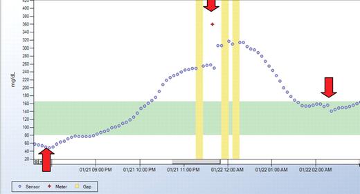 Figure 3. Glycemic response to a pizza meal illustrated on a line graph(DexCom Data Manager 2 Software). At 8:00 p.m., the patient began eating three slices of cheese, chicken, and garlic pizza at the time of the insulin injection. Peak glucose occurred 3.5 hours later, and a correction bolus was given. Full recovery from postprandial hyperglycemia occurred 5.5 hours after start of the meal. (Courtesy of DexCom)