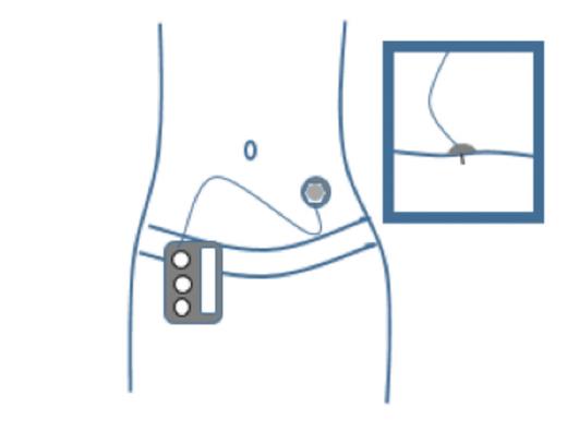 FIGURE 1. Insulin pump with tubing. The tubing connects the insulin pump, which contains the reservoir where the insulin is held, to the infusion cannula inserted in the subcutaneous tissue.