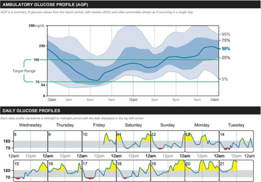 FIGURE 1. Case 1 AGP report interpretation. Patient history: Type 2 diabetes on metformin 1,000 mg twice daily, once-weekly glucagon-like peptide 1 receptor agonist, and 80 units insulin glargine at night. Quick analysis: Panel 1. Ask: Is action needed? Answer: Yes, both TIR and time below range (TBR) are not at target. TIR = 46% (target >70%); TBR (Low + Very Low) = 10% (target <4%); and TBR (Very Low) = 5% (target <1%). Panel 2. Ask: Where is action needed? Address hypoglycemia first. Note that from 4:00 to 8:00 a.m., 25% of values are <70 mg/dL, and from 3:00 to 6:00 a.m., 5% of values are <54 mg/dL. Note the classic “stair-step” pattern of postmeal elevations associated with overbasalization (continued titration of basal insulin without attaining glycemic targets). Panel 3. This graphic representation of data confirms low and high glucose occurring on both weekends and weekdays. Plan: Reduce basal insulin (we went to 36 units of glargine) and add premeal rapid-acting insulin (14 units at breakfast, 10 units at lunch, and 12 units at dinner). Also, work on consistency of food intake and exercise to address the considerable glucose variability.